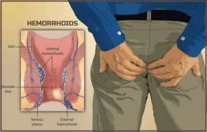 Best piles clinic in hyderabad