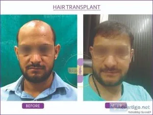 Hair transplant cost in delhi | hair transplant in delhi- dr sye