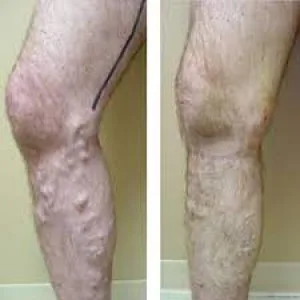 Best varicose veins doctor in jaipur