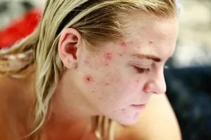 Acne Laser Therapy