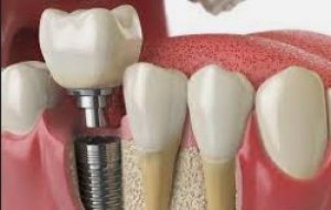 Dental implants