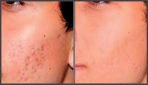 Laser resurfacing treatment cost in chennai