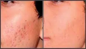 Laser resurfacing treatment cost in chennai