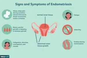 Best endometriosis doctor in jaipur