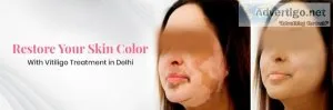 Vitiligo treatment in delhi | dr shankila mittal