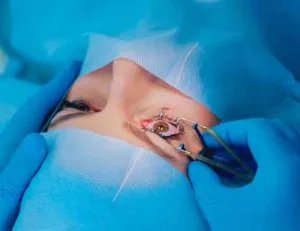 Lasik surgery in bangalore, best lasik eye surgeon in bangalore