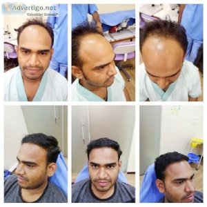 Hair fall treatment in jaipur