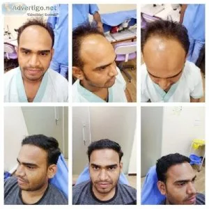 Hair fall treatment in jaipur