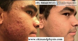 Best treatment for acne /pimples