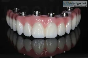 Full-mouth dental implants in india