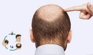 Best hair transplant in india - dr a?s cinic