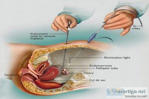 Laparoscope treatment in india