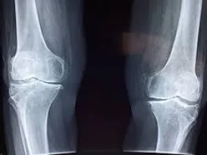 Orthopedic doctor in magarpatta | orthopedic surgeon in magarpat