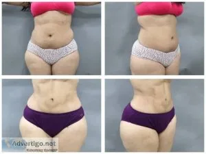 Liposuction cost in delhi - handa aesthetics