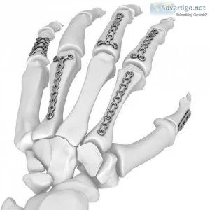 High-quality orthopedic implants plates