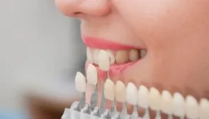 Teeth whitening dentist in noida vaishali call 9650780998