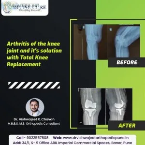 Best orthopedic doctor/ orthopedic surgeon in baner, pune- dr vi