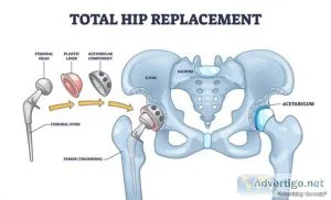 Hip replacement surgeons in kothrud | best hip replacement docto
