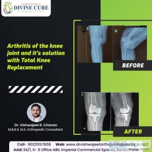 Best knee replacement surgeon in baner- dr vishwajeet chavan
