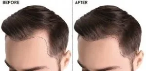 Is hair transplant permanent-medlinks