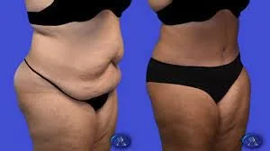 Tummy tuck surgery in gurgaon-handa aesthetics