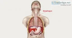 Esophageal cancer treatment in delhi -dr arvind