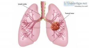 Best lung cancer treatment in india - drarvind