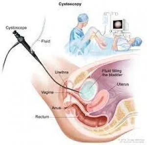 Best cystoscopy hospitals in delhi- irene hospital