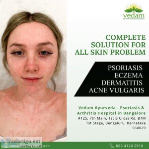 psoriasis ayurveda treatment