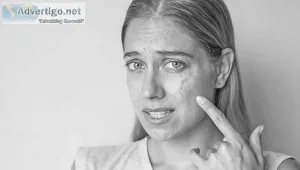 Best acne treatment in delhi dr rajat kandhari