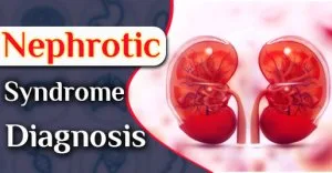 Nephrotic syndrome ayurvedic treatment