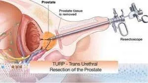 Turp surgery in delhi- irenehospital