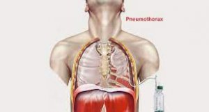 Pneumothorax treatment cost in india- dr arvind