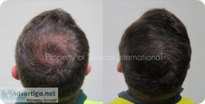 Hair loss treatment