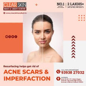 Best advance acne scar removal treatment in india || laser treat