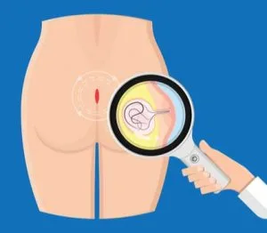 Pilonidal sinus doctor in faridabad
