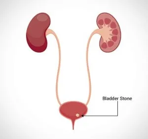 Bladder stone surgery cost in delhi