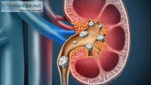 Best kidney stone hospital in chennai india
