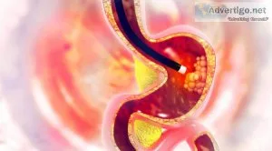 Upper gi endoscopy cost in ahmedabad