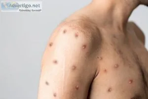 Monkeypox - symptoms, transmission, and treatment