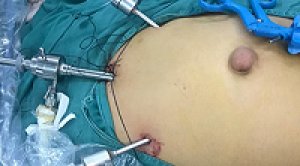 Best hospital for hernia surgery in ahmedabad