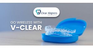 V-clear aligners