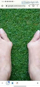 Looking For People With Bunions