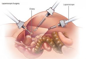 Laparoscopy for infertility cost