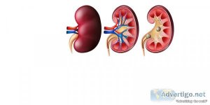 Dr niren rao: kidney stone treatment in delhi