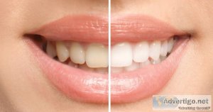Teeth whitening dubai