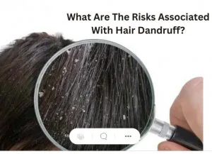 What risks of dandruff are associated with it?