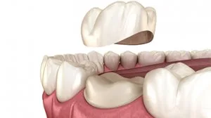 Teeth cap treatments clinic in thakur village/thakur complex/kan