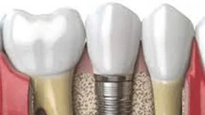Quality implant treatments at the best implant clinic in thakur 