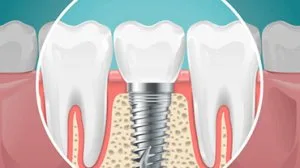 Dental implant treatment clinic in thakur village, mumbai